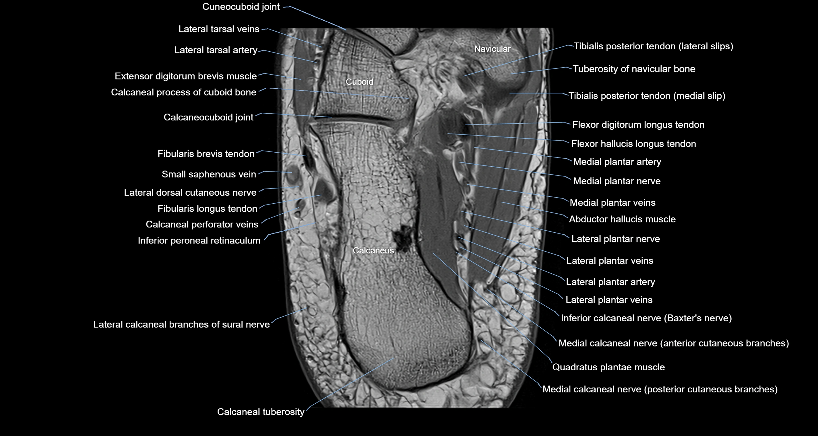 Ankle axial anatomy 3T MRI images -img-10001-00032.webp
